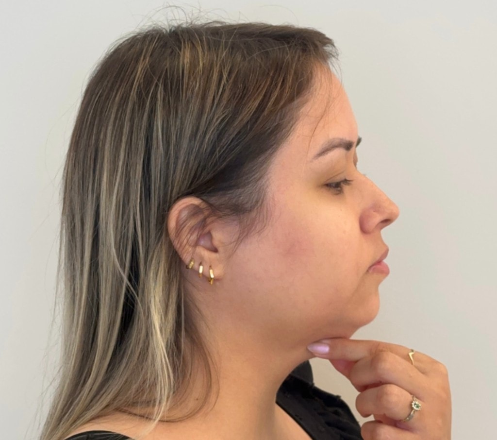 Mulher em perfil indicando a região submentoniana, ilustrando o foco da lipo enzimática de papada.