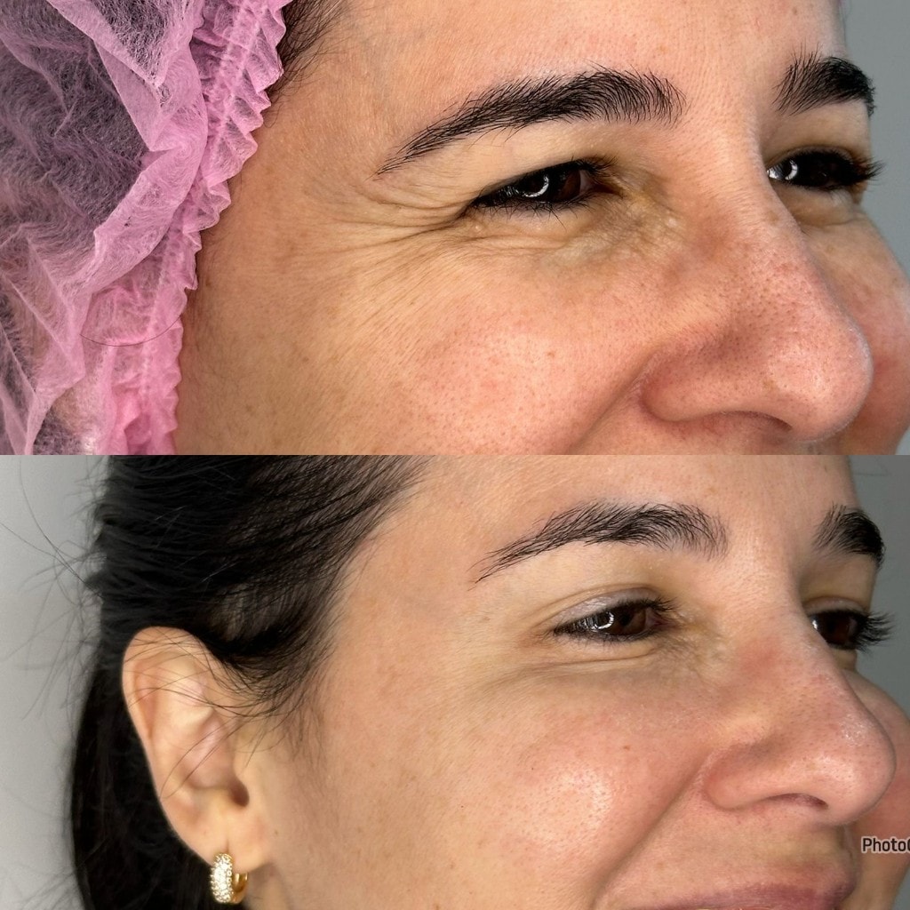 Avaliação facial para planejamento da aplicação de toxina botulínica.
