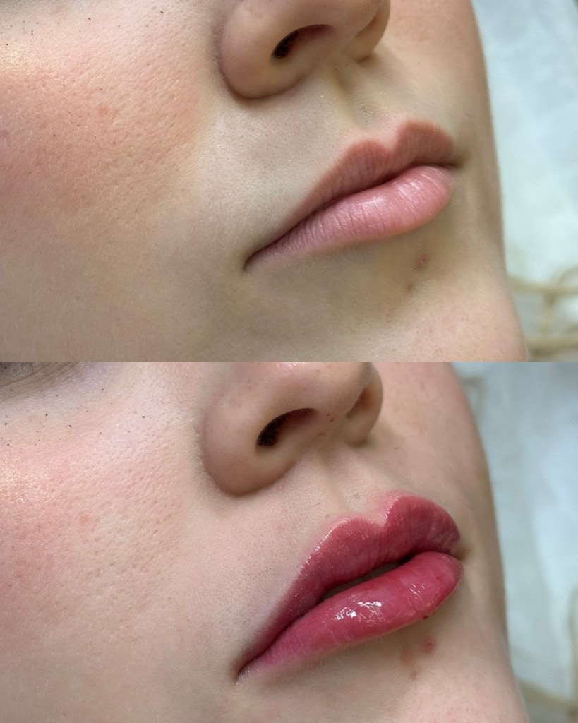 Comparação antes e depois de preenchimento labial com harmonia e proporção.