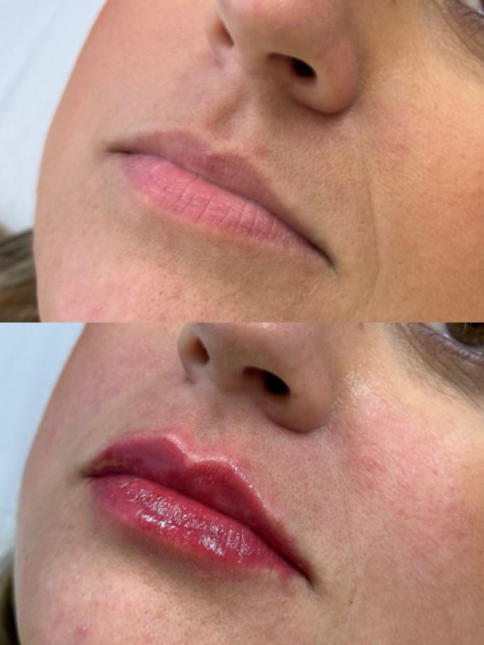 Comparação antes e depois de preenchimento labial com resultado personalizado.
