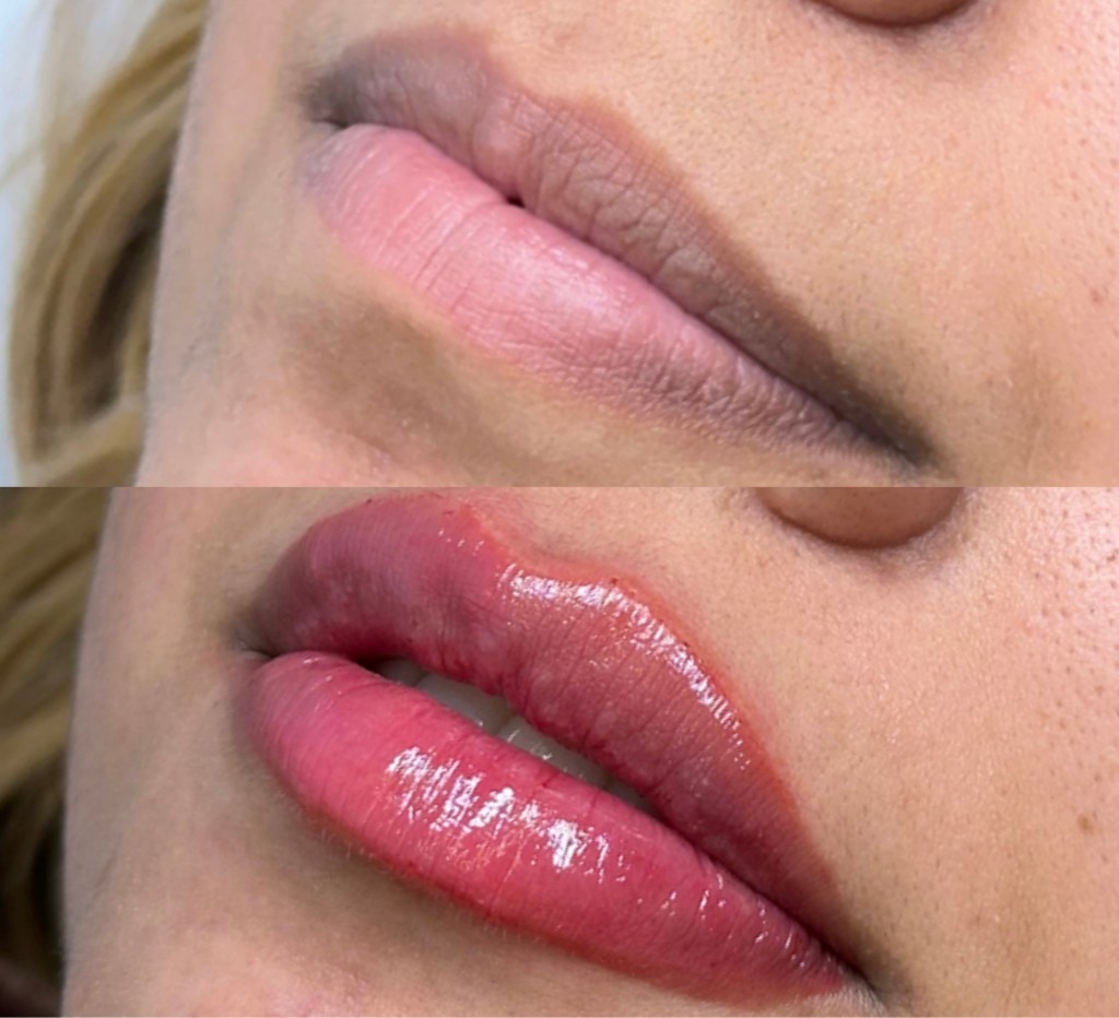 Comparação antes e depois de preenchimento labial.