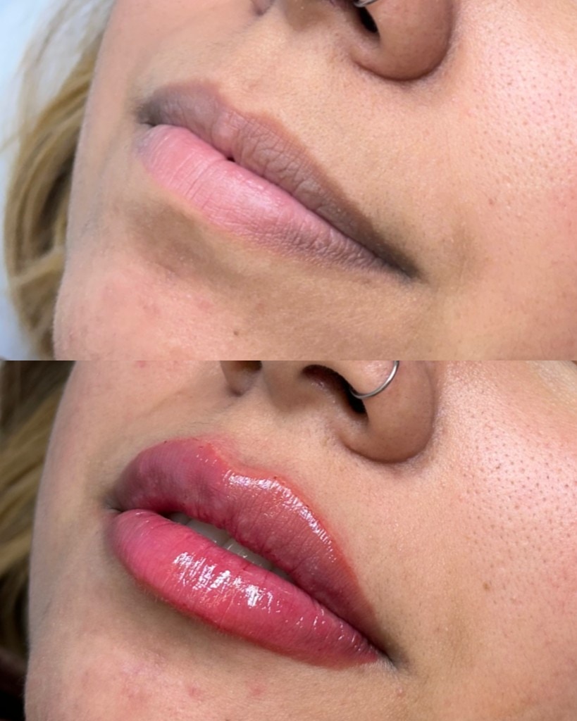 Comparação antes e depois de preenchimento labial com mais contorno e hidratação.