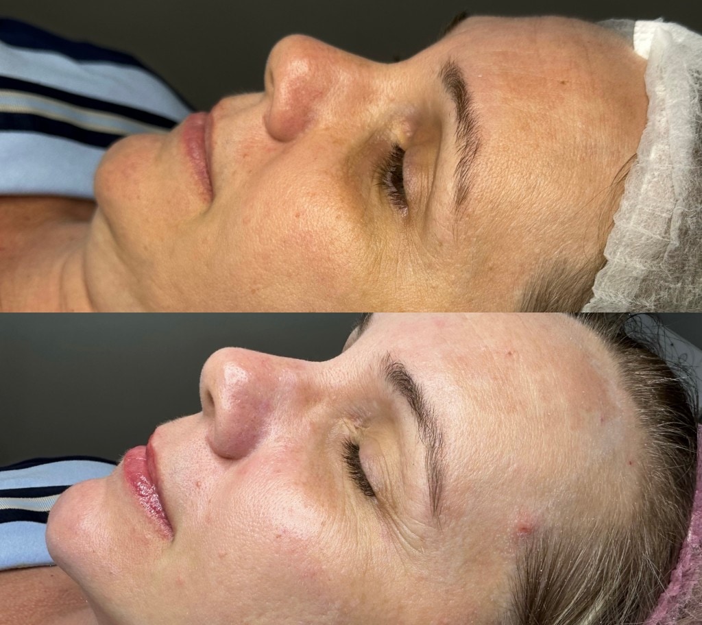 Comparação antes e depois de tratamento com Laser Lavieen, com melhora de textura e luminosidade da pele.
